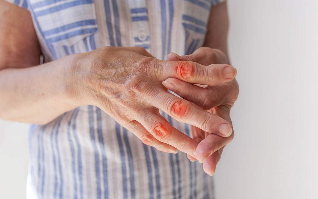 Artritis vs. Artrosis: Diferencias, Tratamientos y Recomendaciones para el Alivio Artritis vs. Artrosis: Diferencias, Tratamientos y Recomendaciones para el Alivio