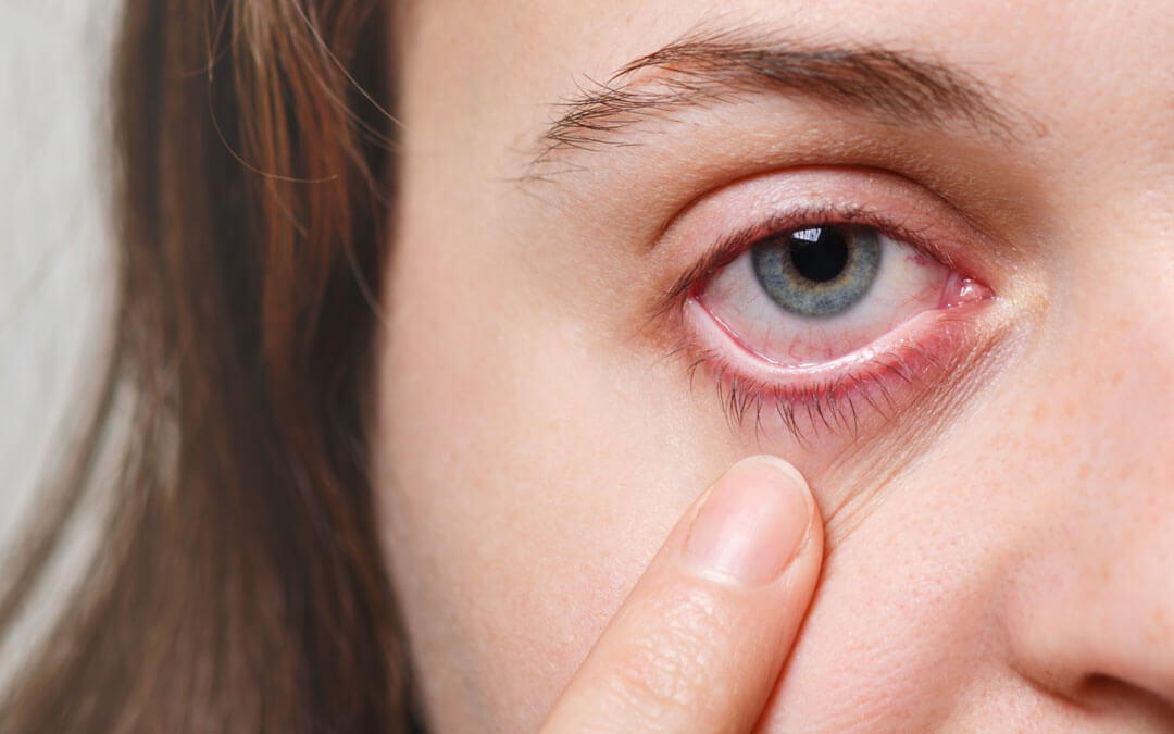 Ojo Seco vs Ojo Irritado por Alergia: ¿Cuál es la Diferencia y Cómo Tratarlos? Ojo Seco vs Ojo Irritado por Alergia: ¿Cuál es la Diferencia y Cómo Tratarlos?